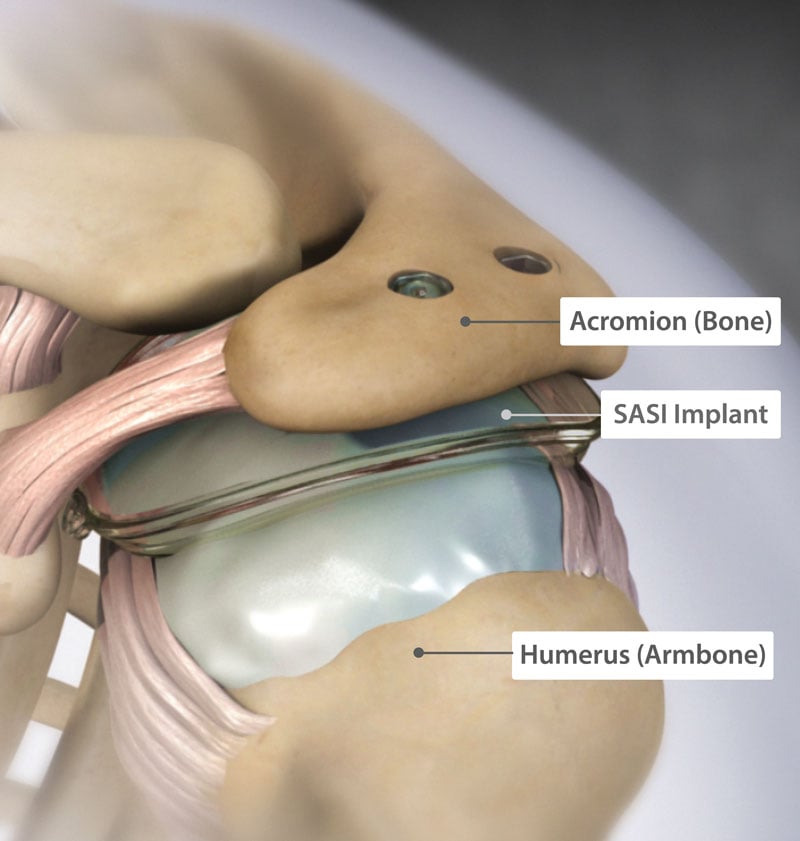 SASI implant in the shoulder.